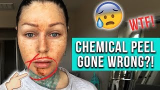 CHEMICAL PEEL GONE WRONG Where have I been  KristenLeanneStyle [upl. by Brendis]