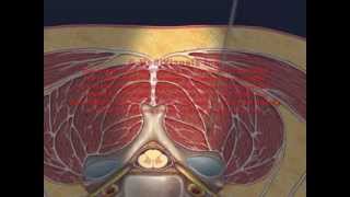 Cervical Interlaminar Epidural Injection Animation [upl. by Auhsohey655]