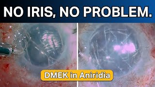 No iris no problem DMEK in aniridia [upl. by Eipper]