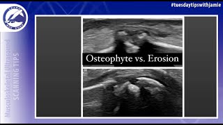 Osteophyte vs Erosion on MSK Ultrasound [upl. by Caddric]