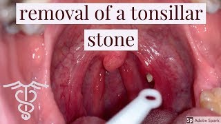 Removal of a tonsillar stone  patient education video by Dr Carlo Oller [upl. by Nnaul592]