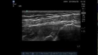 Ultrasound Arthrogram  Posterior labral tear [upl. by Ricardo]