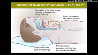 Hypoglossal nerve stimulation for obstructive sleep apnea [upl. by Yaya]