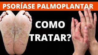 PSORÍASE PALMOPLANTAR NOS PÉS E NAS MÃOS COMO TRATAR  SAIBA [upl. by Fugate769]