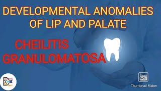 DEVELOPMENTAL ANOMALIES OF LIP AND PALATE PART3 CHEILITIS GRANULOMATOSA [upl. by Anitel446]