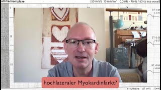 EKGQuickie Hochlateraler Myokardinfarkt [upl. by Hedges241]