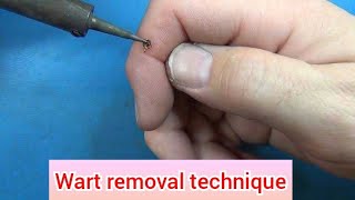 WART REMOVAL ELECTROCAUTERY [upl. by Issirk356]