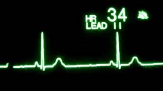 Sinus Bradycardia [upl. by Clementina]