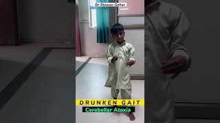 Ataxic or drunken gait ataxicgait drunkengait cerebellarataxia fredreichataxia ataxia [upl. by Tierza]