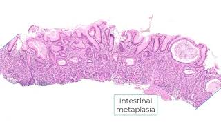 Autoimmune gastritis and differential diagnosis [upl. by Jeralee]