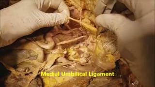 Pelvic Narrative Surgical Dissection  Iliac Artery Branches  Sanjoy Sanyal [upl. by Igic436]