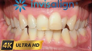 INVISALIGN treatment for 10 MONTHS 4k timelapse [upl. by Colville789]