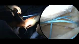 Meniscal Repair [upl. by Tilden]