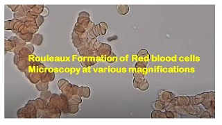 Rouleaux Formation of Red blood cells Microscopy at various magnifications [upl. by Adolf]