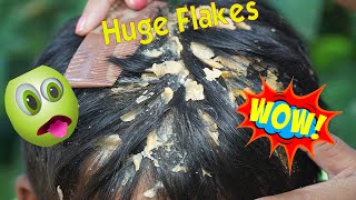 Psoriasis treatment  Dandruff Removal  Itchy Scratching  Huge Flakes Part 255 [upl. by Stegman]