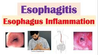 Esophagitis Esophagus Inflammation Causes Risk Factors Signs and Symptoms Diagnosis Treatment [upl. by Nhguavoj60]