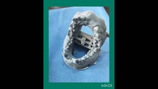 zirconia Crown fabricated with help of Dental Scan without impression procedure [upl. by Ellecrad]