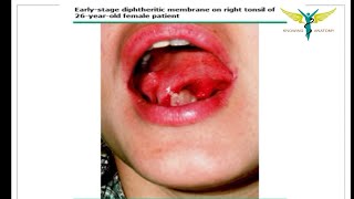 Diphtheria  Causes  Epidemiology  clinical types  Treatment [upl. by Schild]