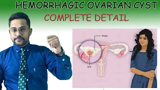 HEMORRHAGIC OVARIAN CYST Treatment [upl. by Bridget]