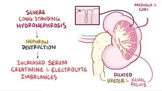 Hydronephrosis  Renal Pathology  Osmosis [upl. by Wappes]