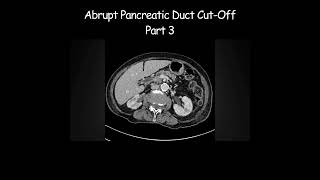 Abrupt Pancreatic Duct CutOff  Part 3 Pancreaticcancer ERCP staging radiology radiologist [upl. by Hal]