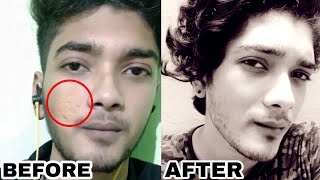 how to cure large pores in tamil  AR STUFFZ [upl. by Godliman]