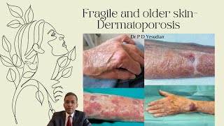 Fragile and thin skin  Dermatoporosis [upl. by Celestia]