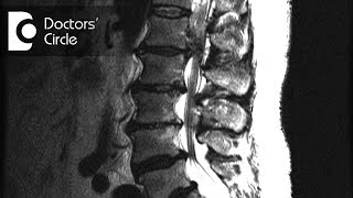 Meaning of disc protrusion with facet joint arthropathy in MRI  Dr Kodlady Surendra Shetty [upl. by Hoj]