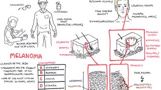 Melanoma  Overview signs and symptoms pathology risk factors treatment [upl. by Eilra]