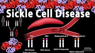 Sickle Cell Disease Animation [upl. by Alleda782]