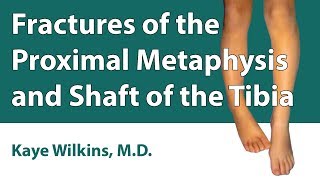 Fractures Of The Proximal Metaphysis amp Shaft Of The Tibia [upl. by Atikahs]