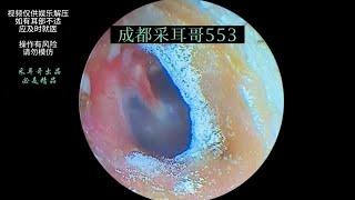 采耳哥Fungal thick dried slices cerumen embolism in both ears ｜553 [upl. by Forbes]