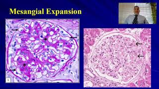 08 Kidney biopsy basics 2 [upl. by Rebekah632]