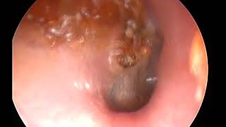 Cholestéatome cholesteatoma Dr DANVIN JB ORL [upl. by Benedict]