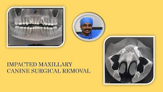 IMPACTED MAXILLERY CANINE SURGICAL REMOVAL [upl. by Edroi]