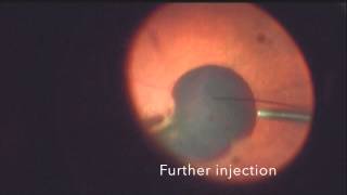 Submacular Tpa for large sub macular bleed in wet AMD [upl. by Reel373]