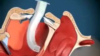 Técnica de Colocação da Cânula Orofaríngea [upl. by Donella657]