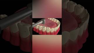 Tooth Cavity Filling Procedure tooth health shorts [upl. by Mya]