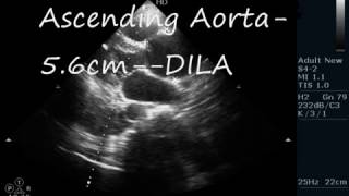 DISSECTION OF AORTA  ECHOCARDIOGRAPHY SERIES BY DR ANKUR K CHAUDHARI [upl. by Montgomery901]