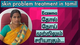 Skin Problem Treatment in Tamil  Eczema தோல் நோய் முற்றிலும் சரியாகும் [upl. by Abbotson134]