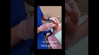 Hammertoe Tendon Release 2nd Toe  No blade no sutures foot [upl. by Salkcin]