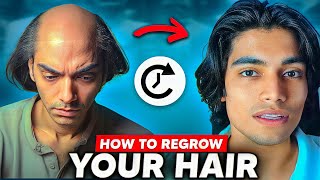 Loosing hairs  50x worse life  How To Stop Hair fall in men  How to fix male pattern baldness [upl. by Auvil]