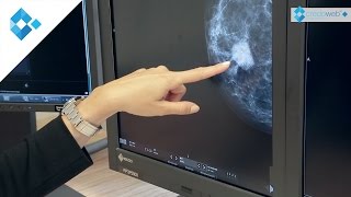 Brustdiagnostik  Knoten frühzeitig erkennen [upl. by Dilks]