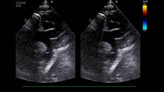 ANOMALIES OF THE AORTIC ARCH INNOMINATE ARTERY ANEURYSM [upl. by Phelips]