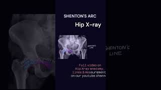 Shentons arc hip Xray anatomy neet radiology radiographyxray orthopaedics pediatrics [upl. by Essa]