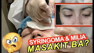 SYRINGOMA amp MILIA REMOVAL MASAKIT BA  Miss Menchie [upl. by Cy671]