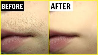 पाएं अनचाहे बालों से छुटकारा  Permanent Hair Removal  Anaysa [upl. by Gilud]