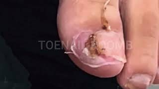 537 Toenail ASMR and Pedicure DIY Toenail ASMR and Pedicure DIY [upl. by Aloisia346]