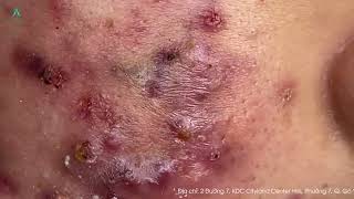 Big Cystic Acne Blackheads Extraction Blackheads amp Milia Whiteheads Removal Pimple Popping [upl. by Reifinnej585]