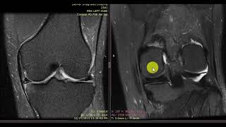 Meniscus PRP Results [upl. by Treboh421]